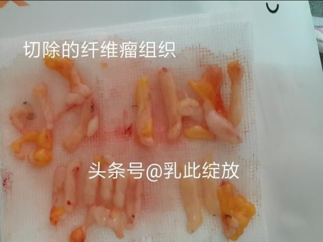 乳腺手术是微创好还是普通的好(乳腺4a手术是微创还是大手术)图2